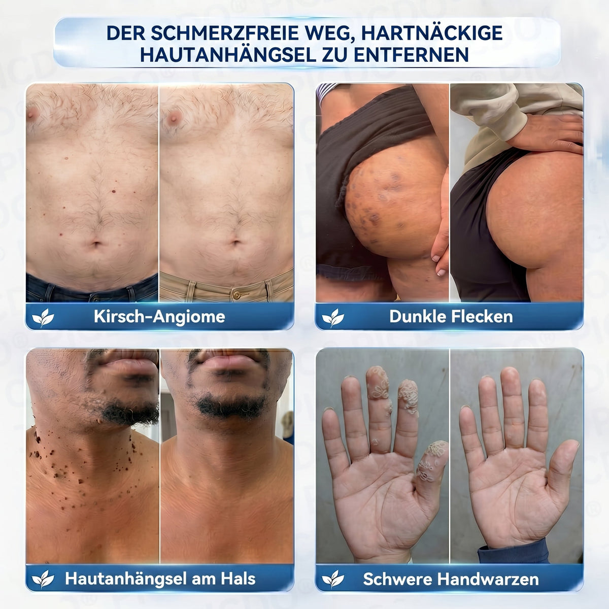 🎁🎁𝐏𝐢𝐜𝐝𝐨® 𝟕-𝐓𝐚𝐠𝐞 𝐂𝐫𝐞𝐦𝐞 𝐆𝐞𝐠𝐞𝐧 𝐇𝐚𝐮𝐭𝐚𝐧𝐡ä𝐧𝐠𝐬𝐞𝐥- & 𝐏𝐢𝐠𝐦𝐞𝐧𝐭𝐟𝐥𝐞𝐜𝐤𝐞𝐧 (𝐒𝐜𝐡𝐦𝐞𝐫𝐳𝐟𝐫𝐞𝐢𝐞 𝐅𝐨𝐫𝐦𝐞𝐥 – 𝐨𝐡𝐧𝐞 𝐍𝐚𝐫𝐛𝐞𝐧)