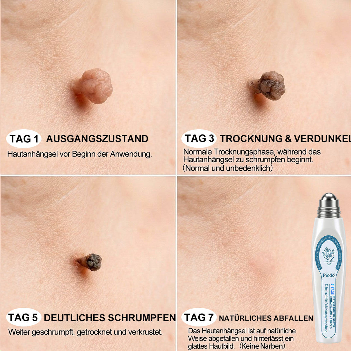 Offizieller Shop | 🎉🎁 𝐏i𝐜𝐝o® 7-Tage-Serum zur Entfernung von Hautanhängseln & Flecken (schmerzfrei, narbenfrei, Roll-On) 🔥